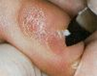 medizinische Fußpflege